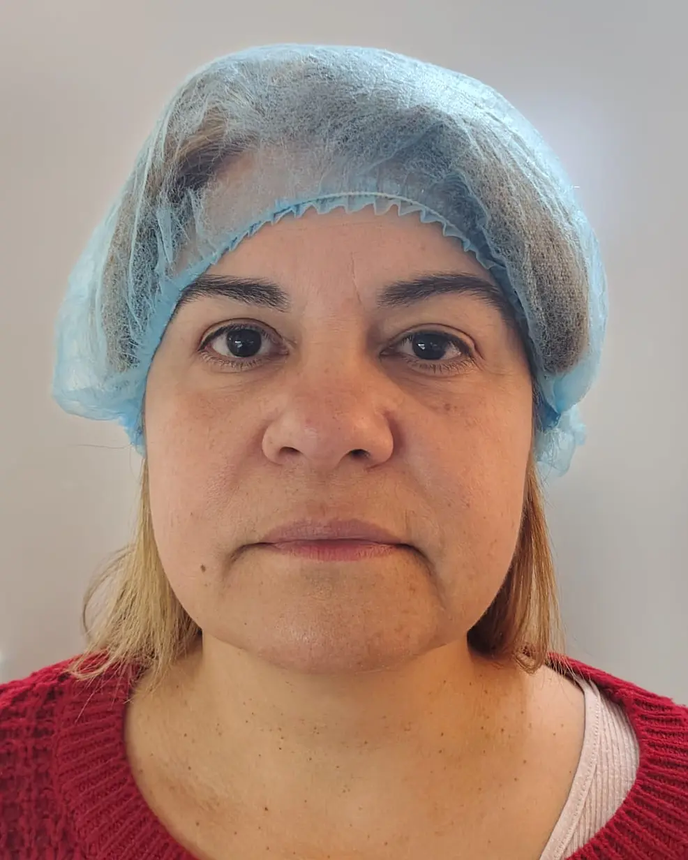 Caso 4: antes del tratamiento
