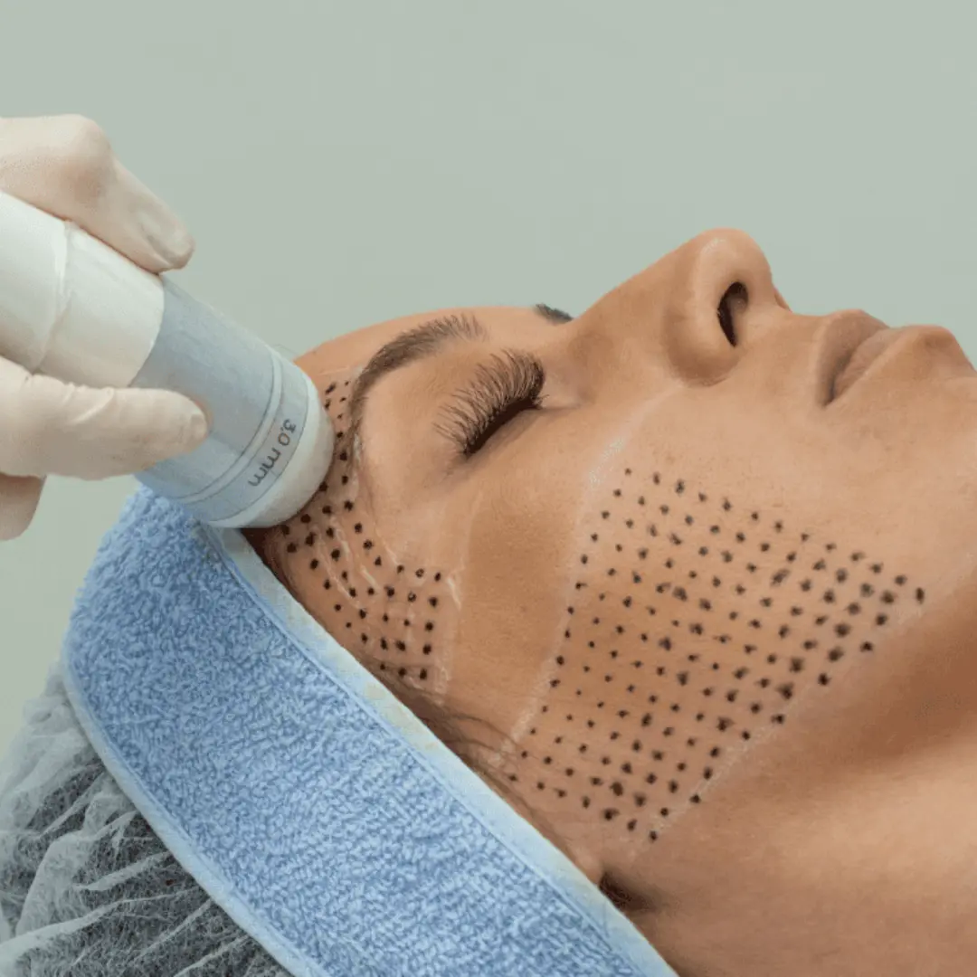 Tratamiento facial en Vianova